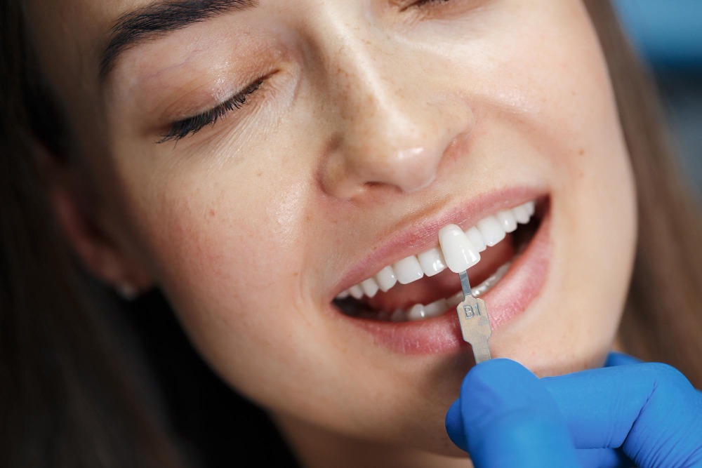 Facetas de resina ou porcelana: qual é mais natural e durável?